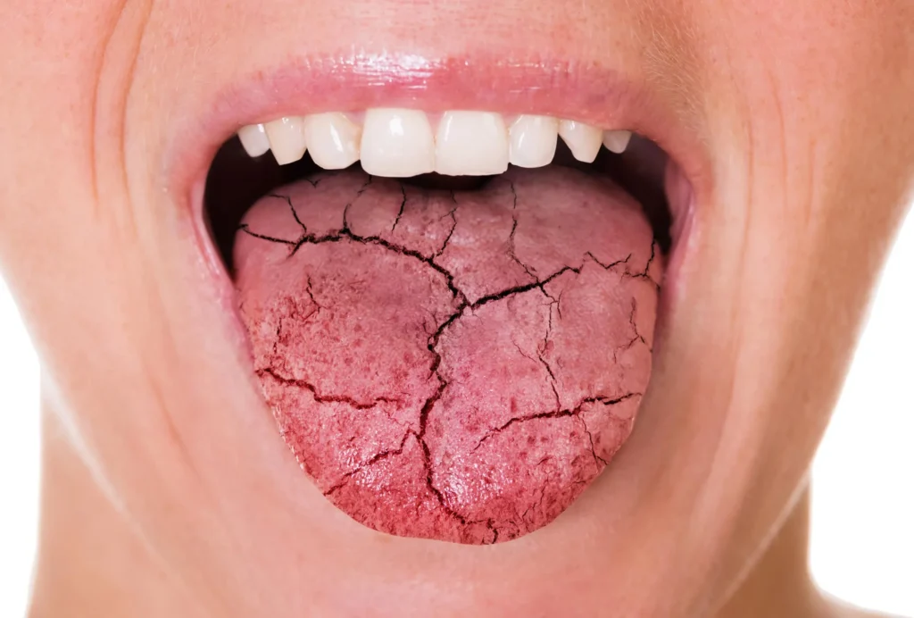 patient with dry mouth needs to see a dentist walnut creek ca