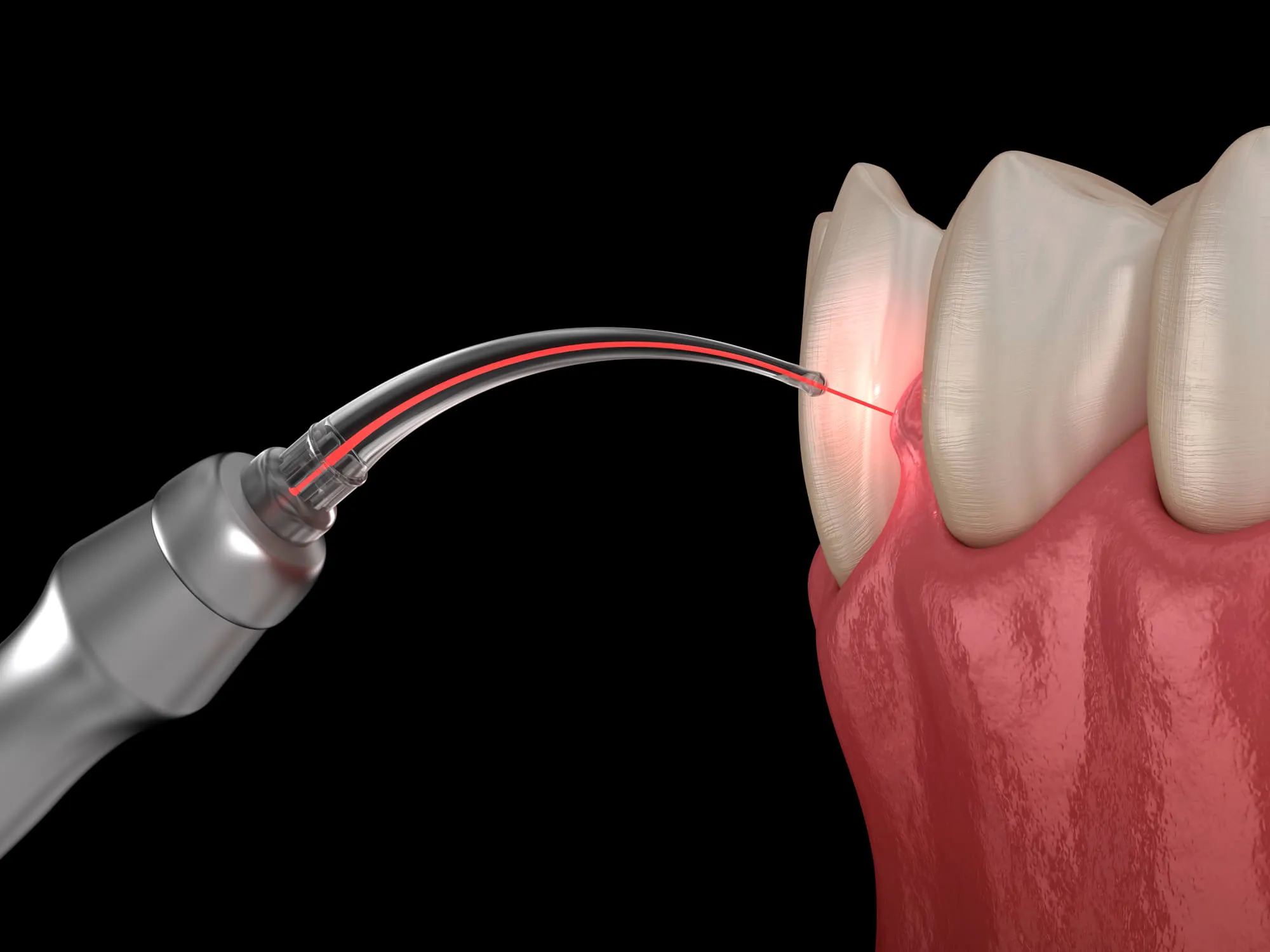 3D image of laser dentistry walnut creek ca