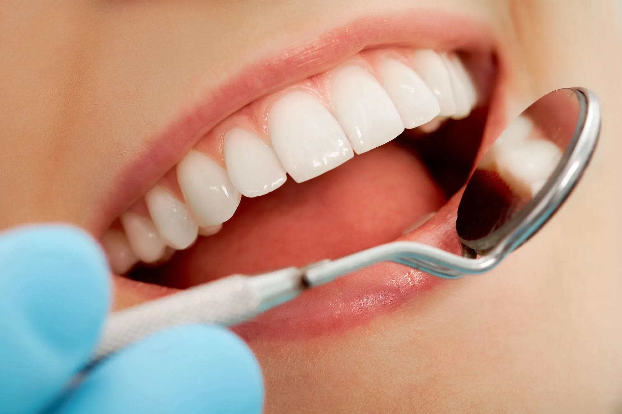after teeth whitening walnut creek
