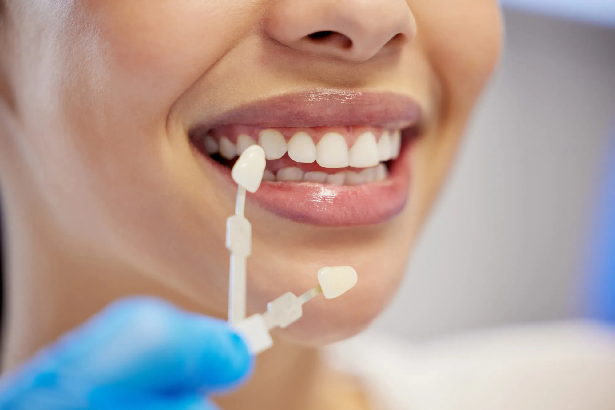 choosing a shade for veneers walnut creek