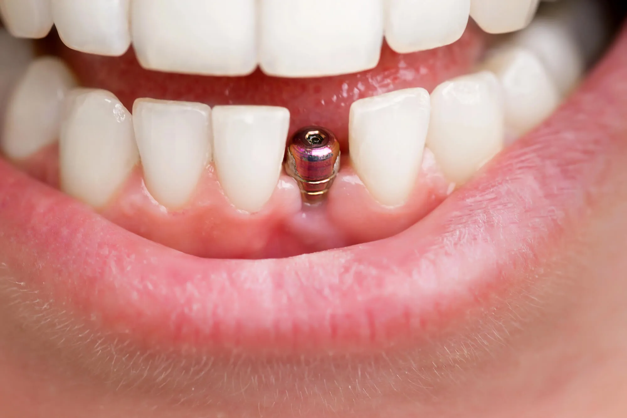 close up view of dental implants walnut creek ca