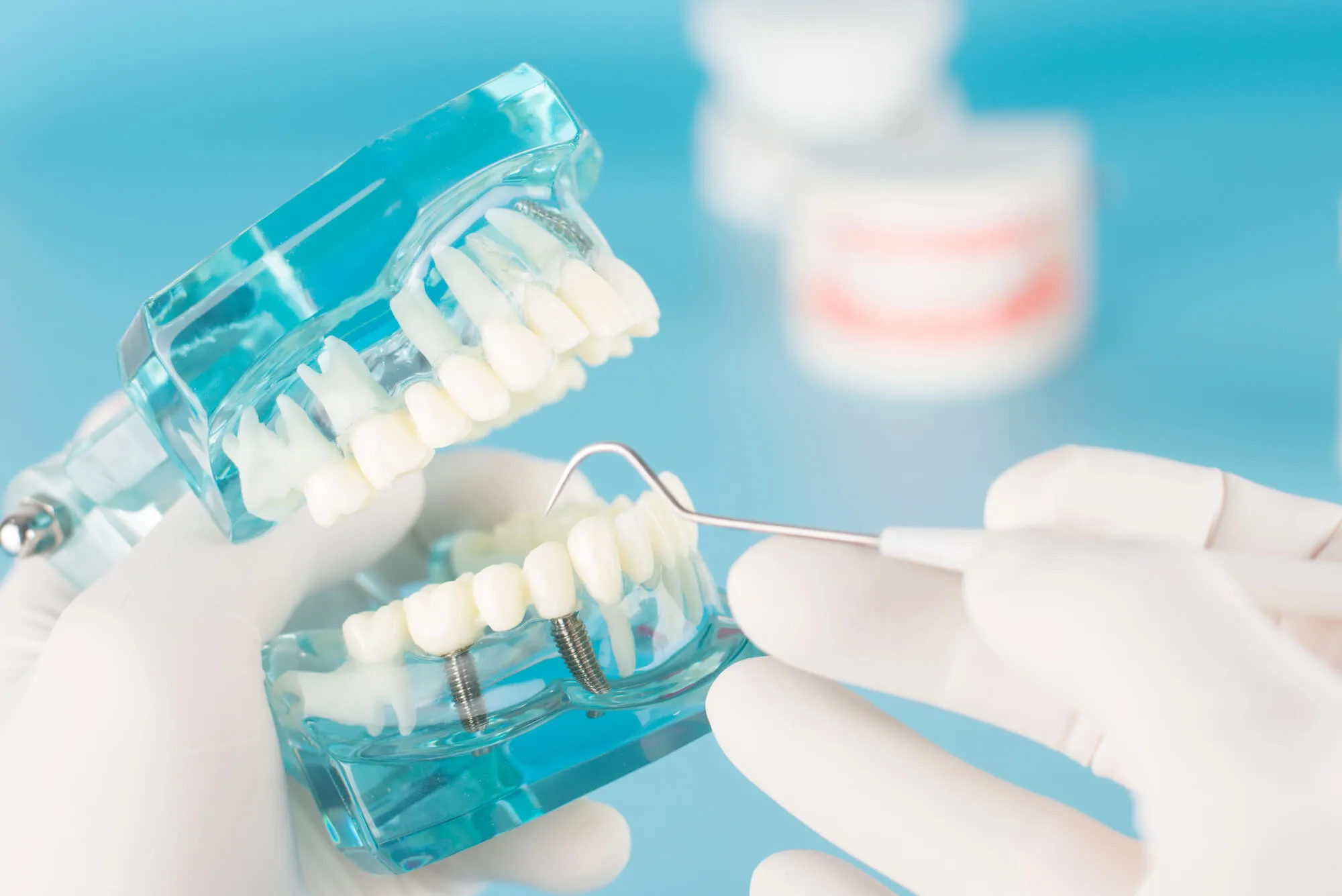 dental implants walnut creek ca model