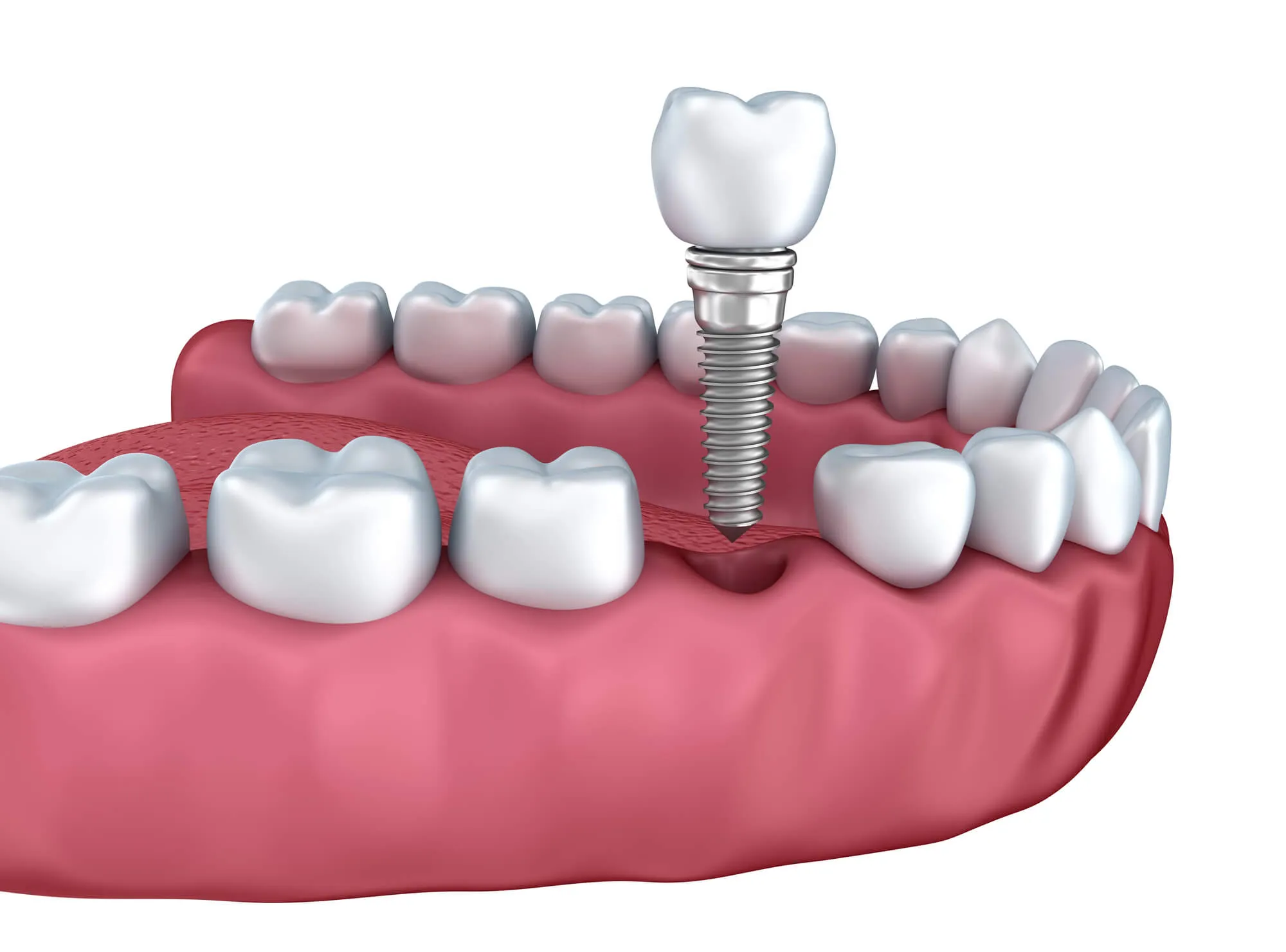 parts of dental implants walnut creek ca
